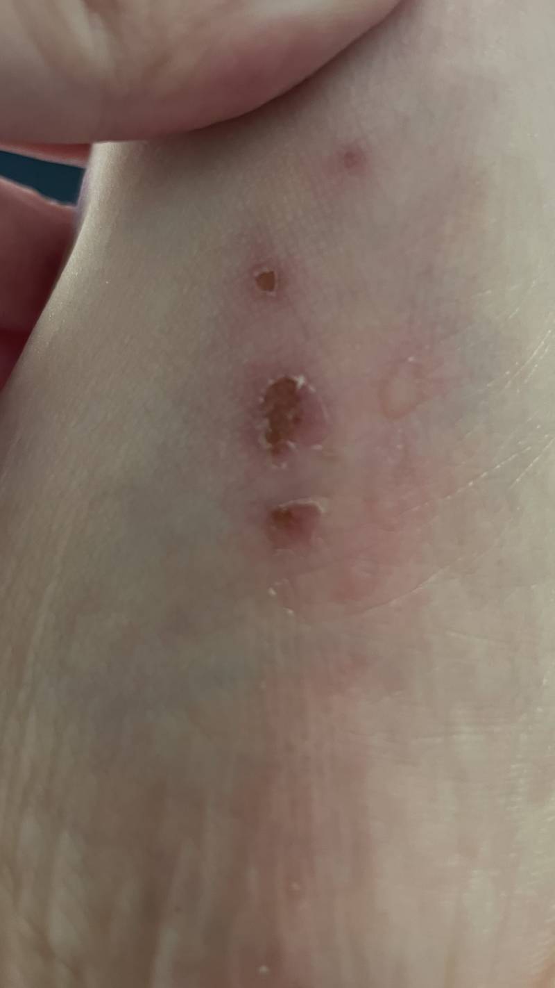 갑자기 발에 수포가 생겼는데 이게 뭘가?? | 인스티즈