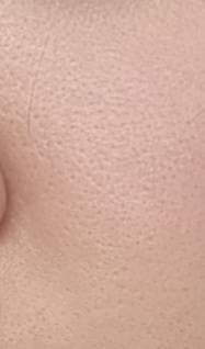 이런 오렌지 같은 피부는 어떻게 해야해? | 인스티즈