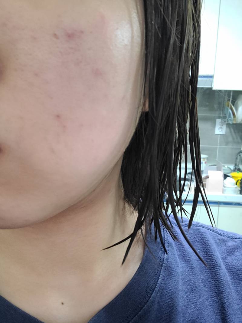 (모공주의) 피부 이거 왜이런거야..? | 인스티즈