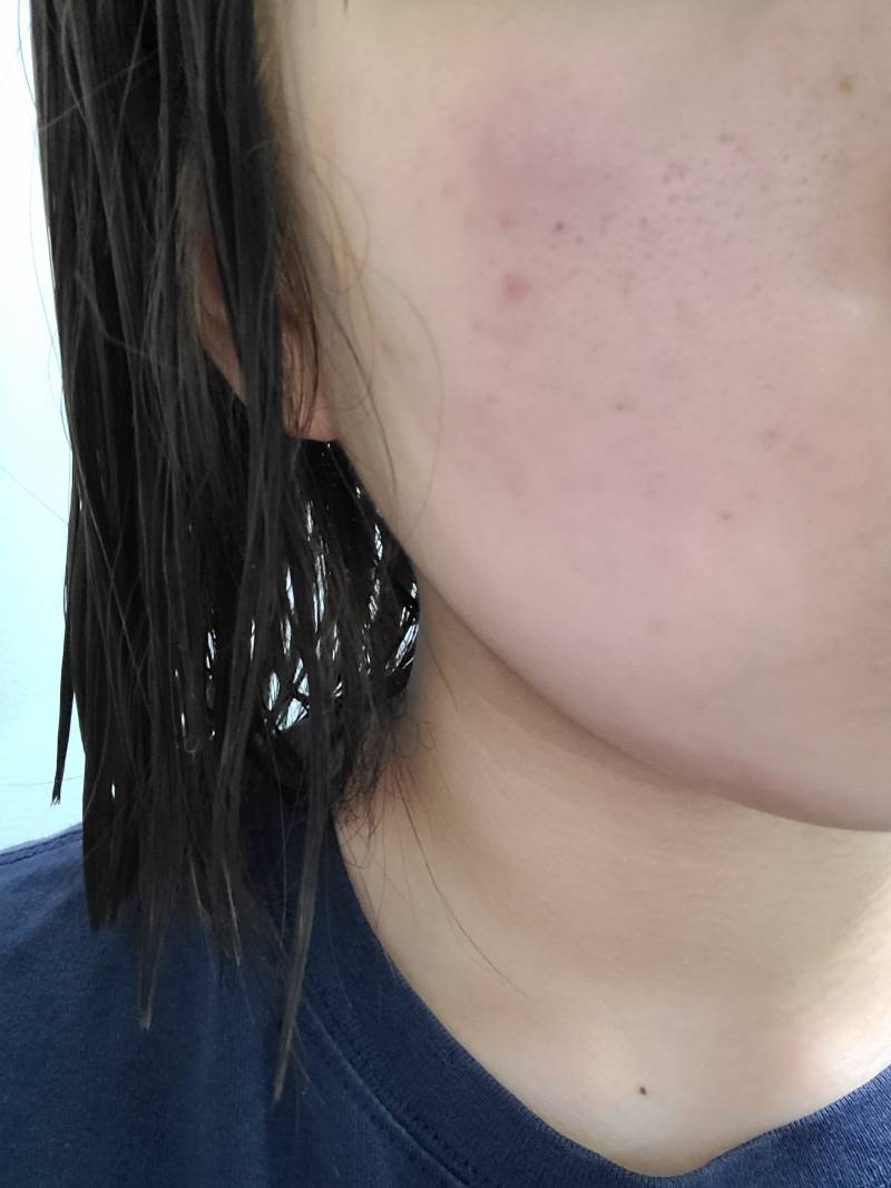 (모공주의) 피부 이거 왜이런거야..? | 인스티즈