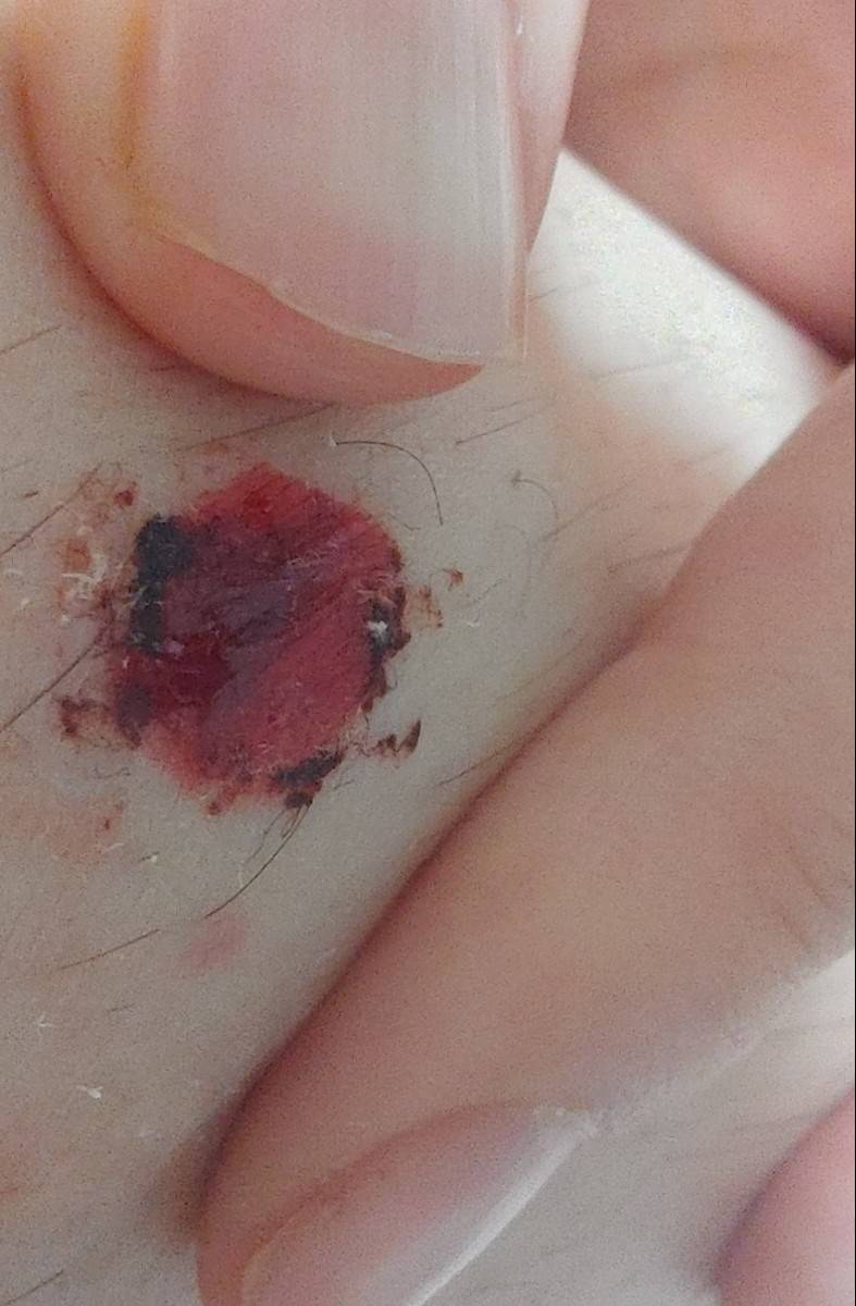 익들아 이런 패인? 상처는 걍 마데카솔 바르고 밴드 붙여놓으면될까? ㅎㅇㅈㅇ | 인스티즈