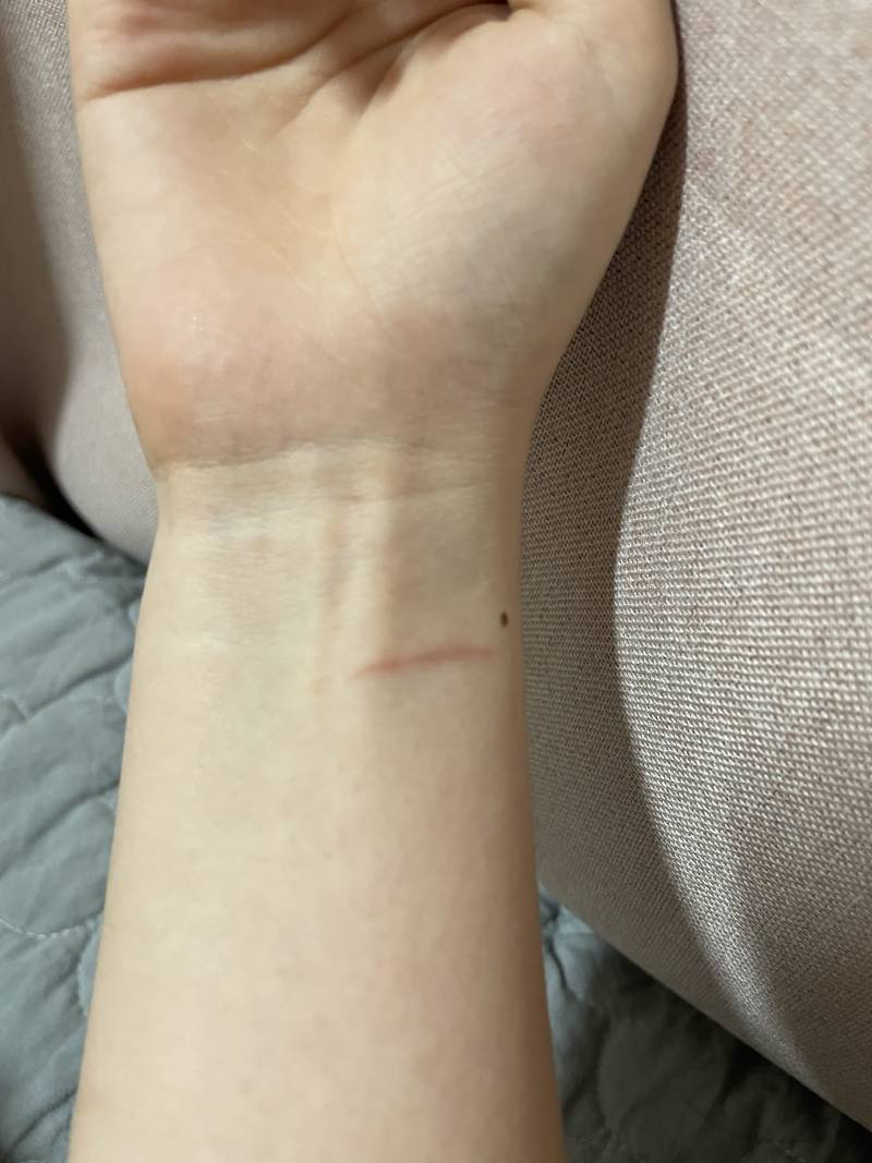 어제 볶음밥 만들다가 손목에 화상입었는데 위치가 참 거시기 하다 | 인스티즈