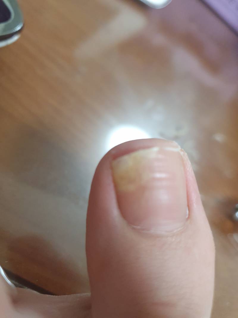 ㅎㅇㅈㅇ 이거 무좀이야?? | 인스티즈