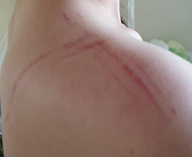 나 오늘 운동하고 어깨 이렇게 됐는데 괜찮은 걸까 | 인스티즈