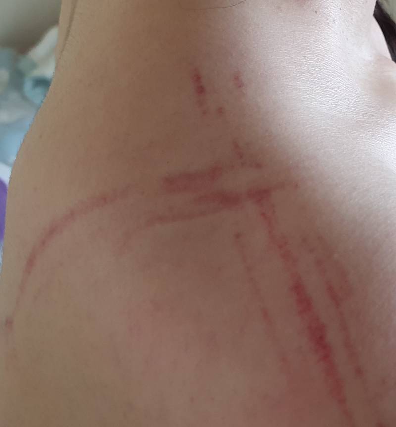 나 오늘 운동하고 어깨 이렇게 됐는데 괜찮은 걸까 | 인스티즈