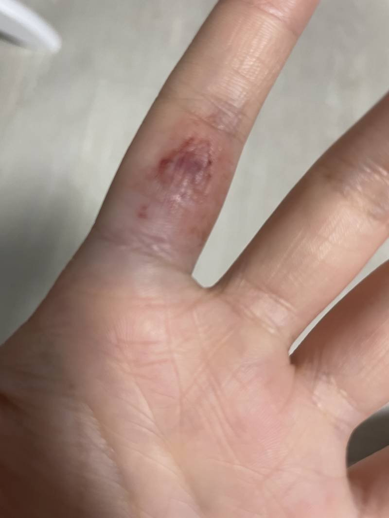 (상처사진주의)익들은 손가락 이렇게 다치면 대학병원 가? | 인스티즈