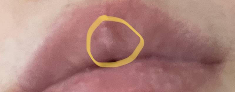 입술 중간에 각질 뜯어서 빨갛게 보이고 하얗게 물집 같은 거 생겼는데 이런 적 있는 익인 ㅜㅜ | 인스티즈