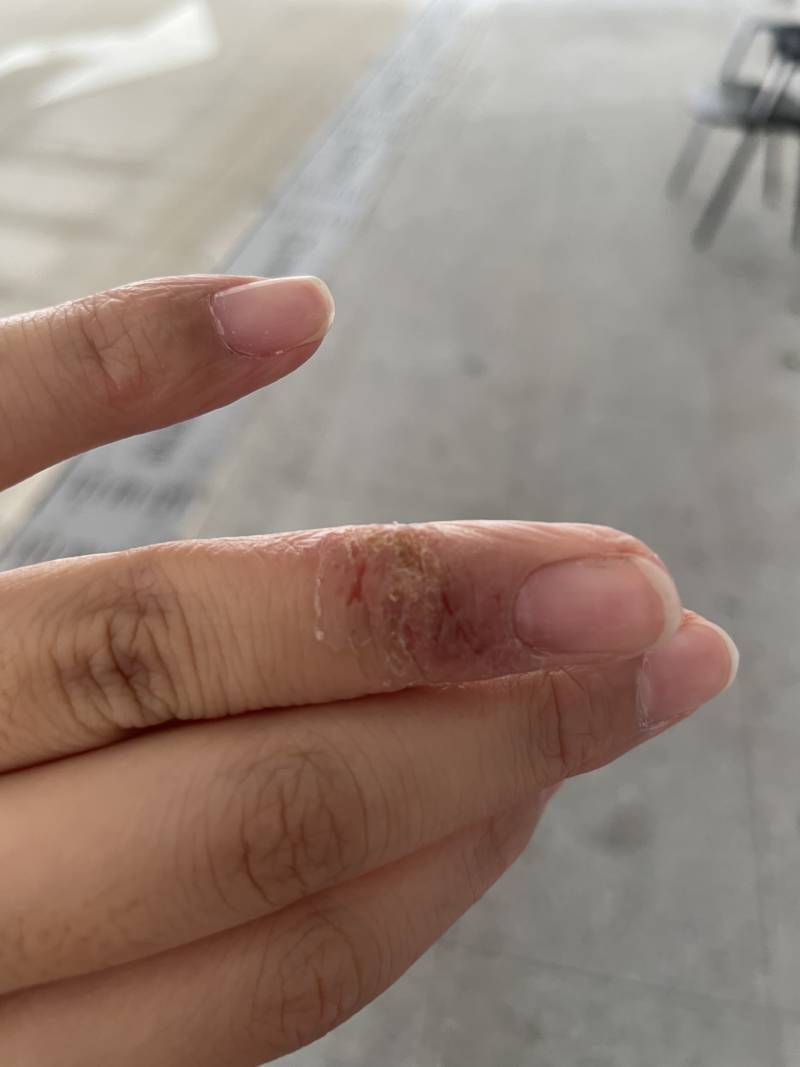 ㅎㅇㅈㅇ 이거 손에 피부가 이렇게 됐는데 습진일까ㅠㅠㅠ | 인스티즈