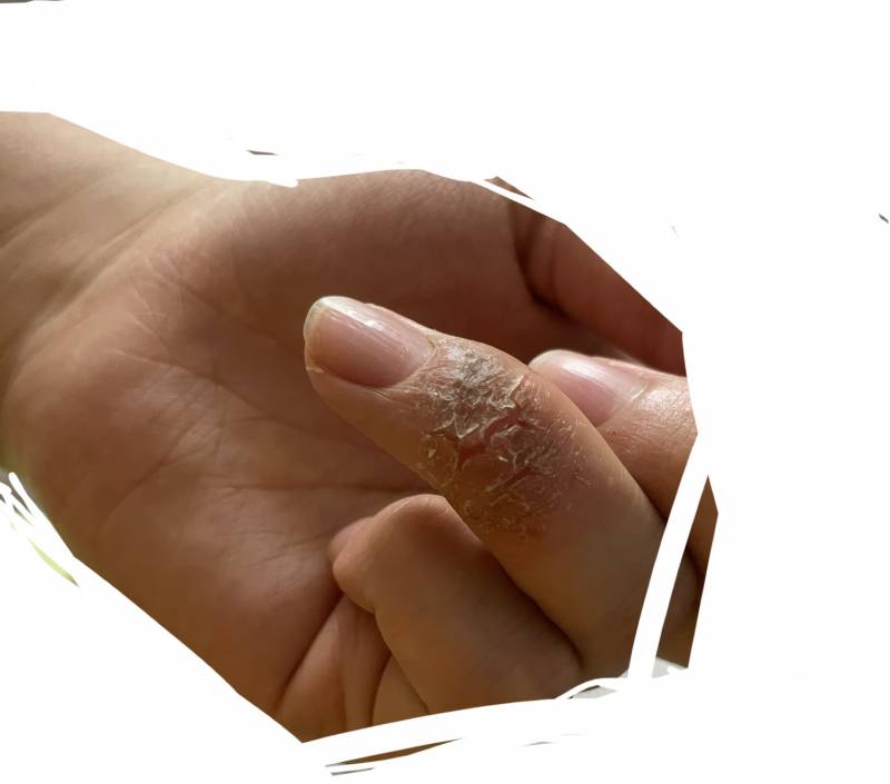 ㅎㅇㅈㅇ 이거 손에 피부가 이렇게 됐는데 습진일까ㅠㅠㅠ | 인스티즈