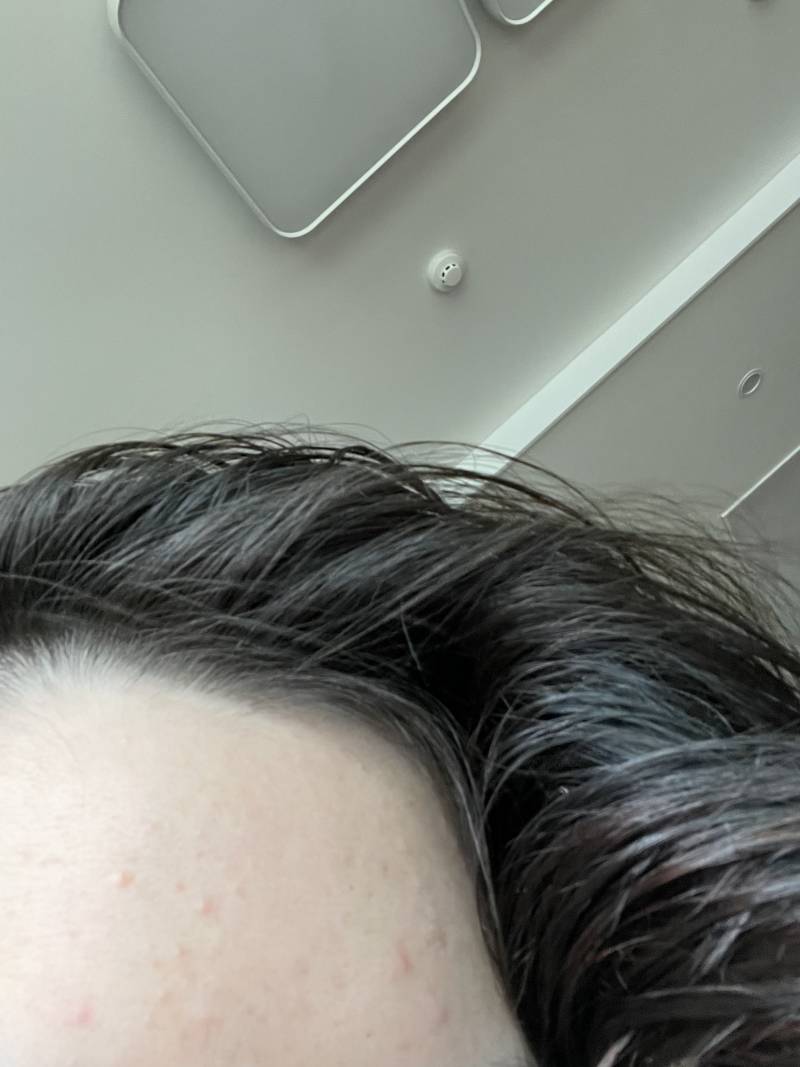 며칠전까지 피부좋았는데 갑자기 피부이런거면 원인이뭐야?(혐오주의) | 인스티즈