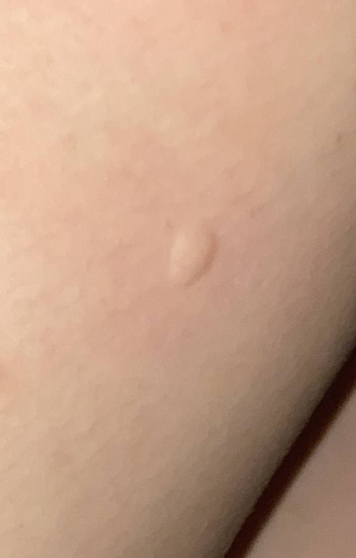 이거 뭐에 물리는 자국일까... | 인스티즈