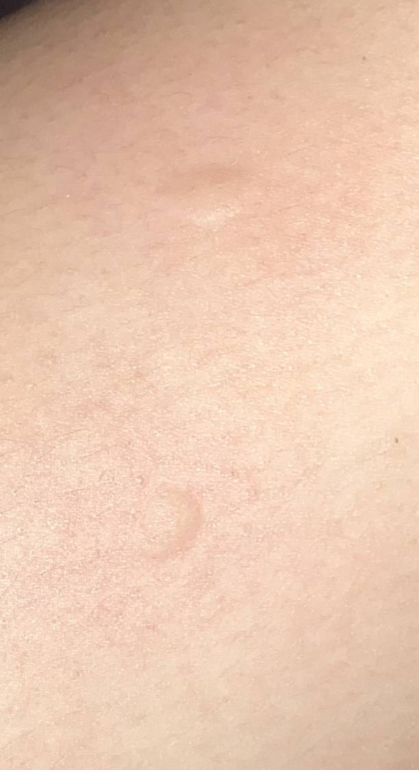 이거 뭐에 물리는 자국일까... | 인스티즈