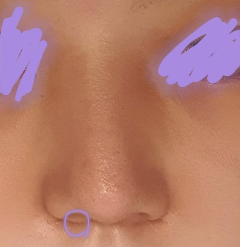 익들이 나라면 콧볼 수술 해 안해??????????????(코 사진 주의) | 인스티즈