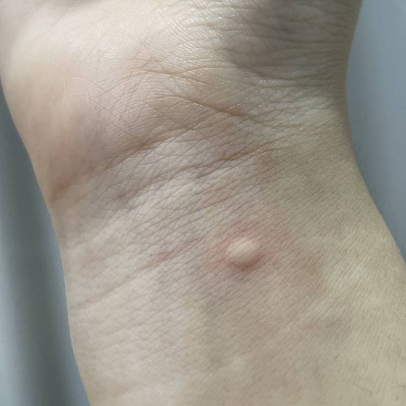 찐소름 나 오늘도 같은 자리에 모기 물렸어 | 인스티즈