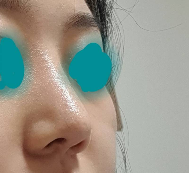 익들이 나라면 콧볼 수술 해 안해??????????????(코 사진 주의) | 인스티즈