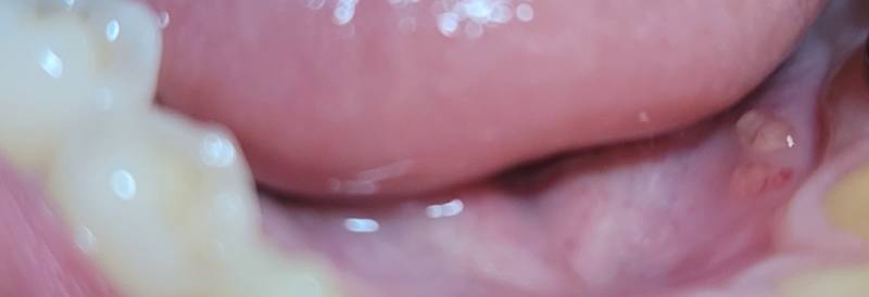 입안에 이런거 생겼는데 구내염 맞아? | 인스티즈