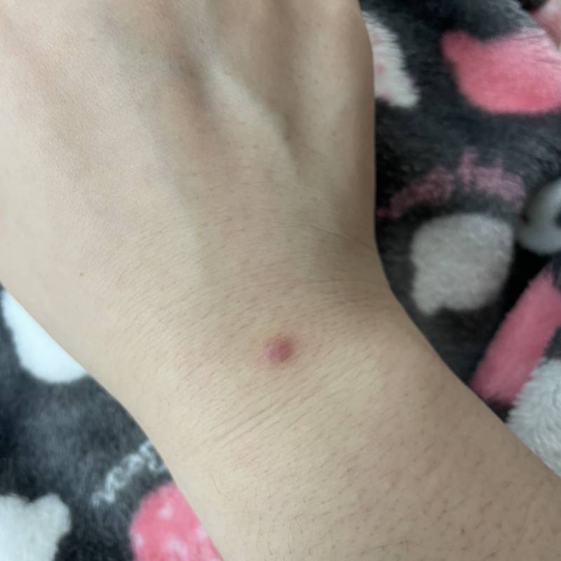 손등에 난 여드름 짰는데 | 인스티즈