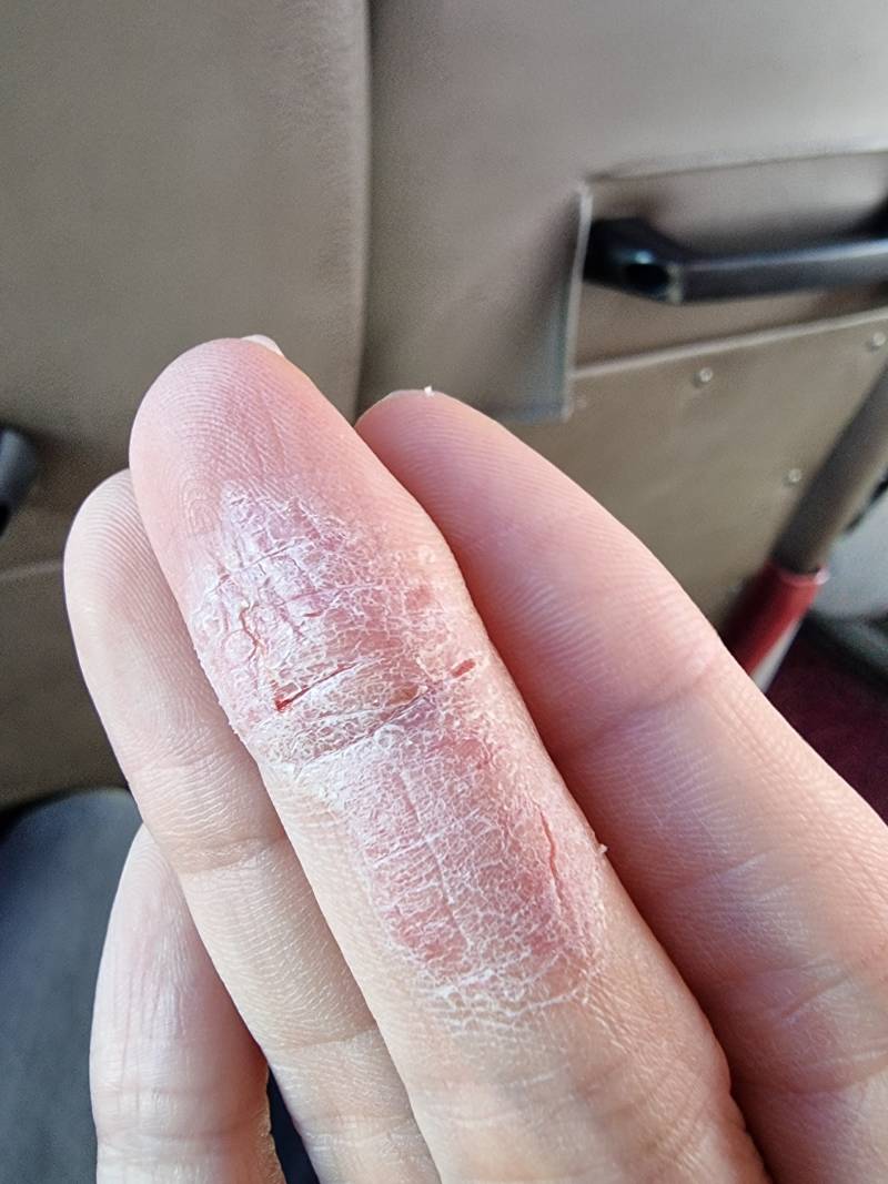 손가락 어떻게 하면 낫지.. | 인스티즈