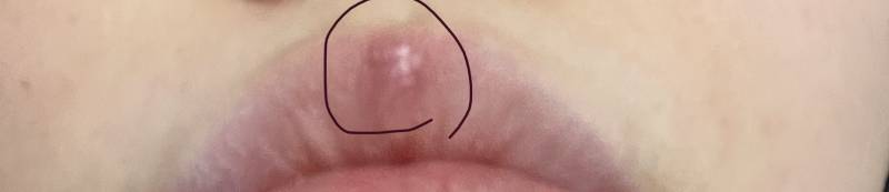 헤르페스 원래 이주넘게 안 나아..? 붓기랑 통증은 없는데 아직도 큰물집이 남아있어 ㅠㅠ 이런 적 있는 익인 | 인스티즈