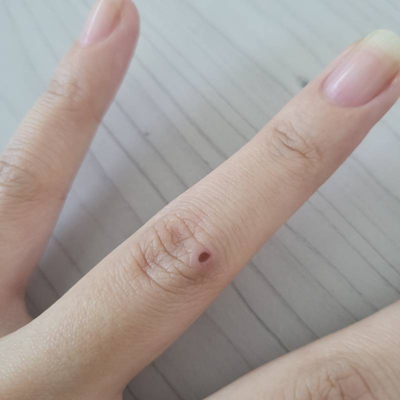 익들아 나 손가락쪽 패인 부분이잇는데 병원가야되나?? | 인스티즈