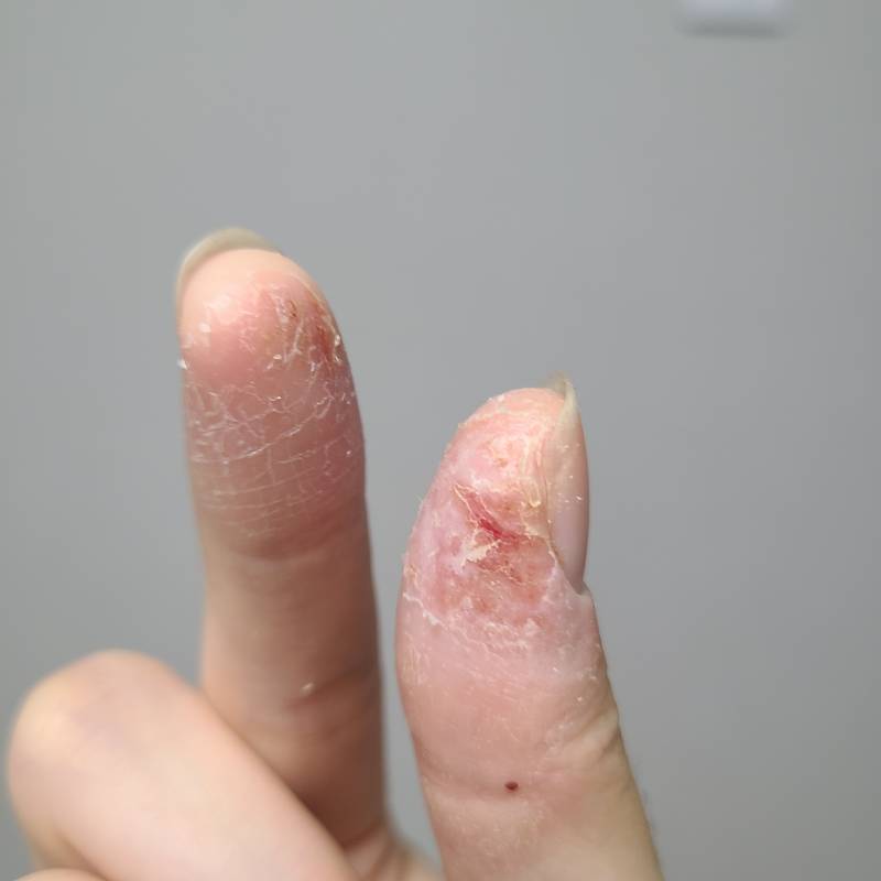 피부과 가도 안 낫는데 어떡하지(ㅎㅇㅈㅇ) | 인스티즈