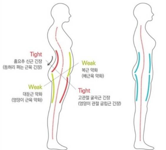 할 골반전방경사 라고 알아 ?????? | 인스티즈