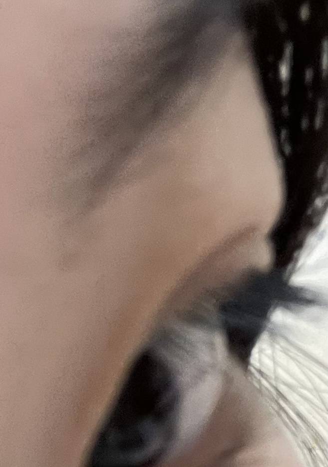 이정도 눈지방이면 나이먹어도 안빠지려나..? 다들 눈지방 언제부터 빠졌어?🥺 | 인스티즈