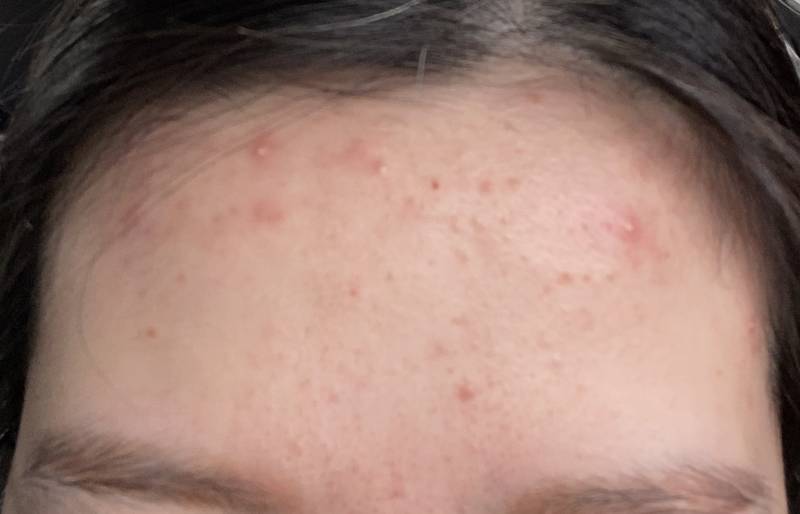 좁쌀이랑 화농성 둘다 있는거지? | 인스티즈