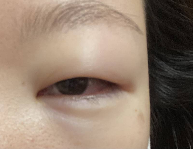 익들아 나 심각하다 내일 면접인데 이거 내일까진 가라앉겠지...? | 인스티즈