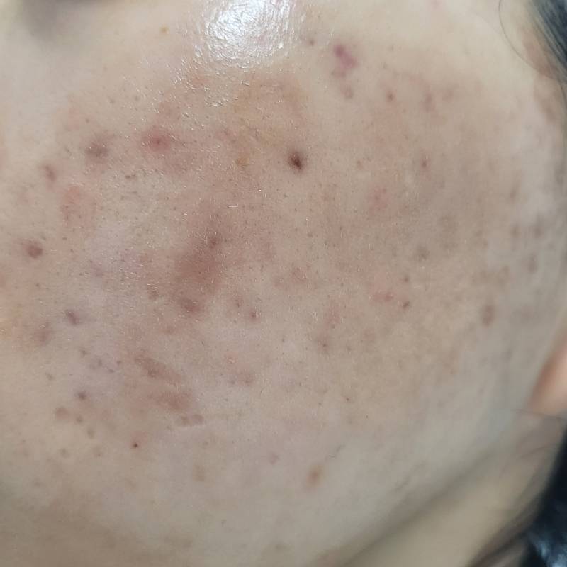 혹시 여드름 흉터 관련 프락셀이나 포텐자나 새살침 받아본 사람ㅠㅠ ㅎㅇㅈㅇ | 인스티즈