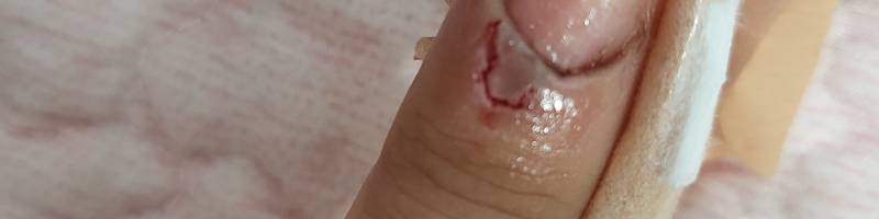 이거 병원 가야할 정도일까 ㅠㅠ(ㅎㅇㅈㅇ) | 인스티즈