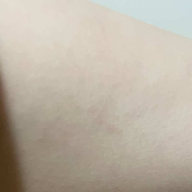 혹시 이거.. 튼살이야? (무식주의) | 인스티즈