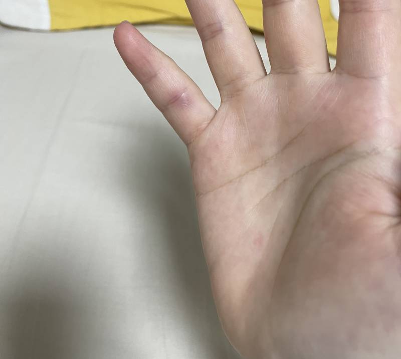 나 갑자기 새끼손가락이 아프더니 멍들었어 뭐지!! | 인스티즈