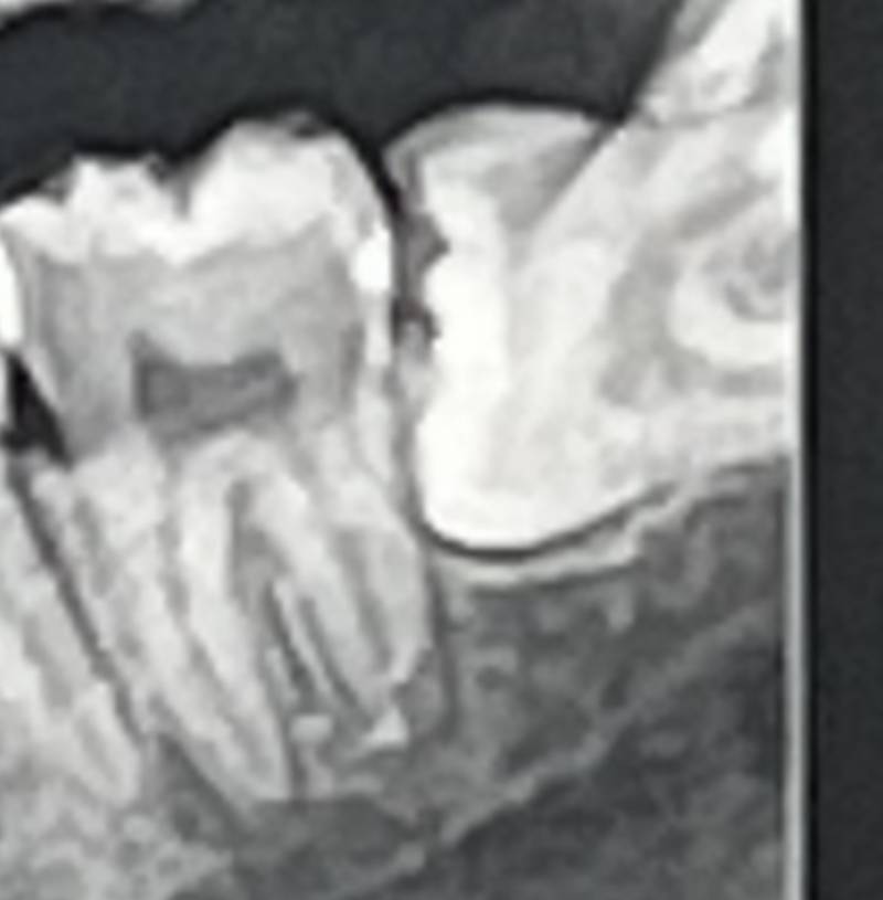 매복사랑니 발치 난이도 얼마일것 같아..?.??.!!! (엑스레이 사진) | 인스티즈