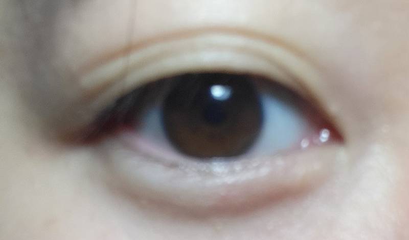 나 쌍수했는데 자연쌍커풀 생겼는데 개이상해.. | 인스티즈