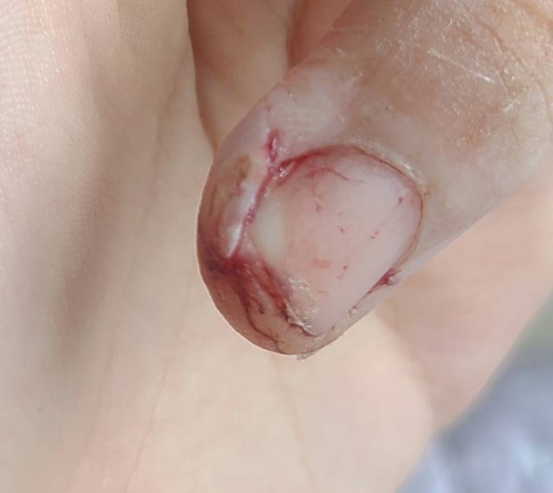 ㅎㅇㅈㅇ 어제 알바하다가 다쳤는데 병원을 가야할까? | 인스티즈