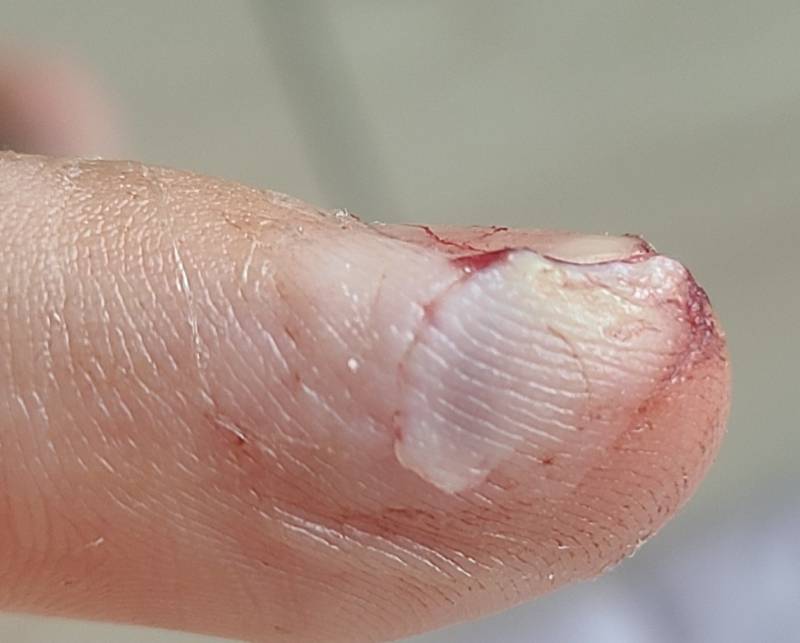 ㅎㅇㅈㅇ 어제 알바하다가 다쳤는데 병원을 가야할까? | 인스티즈