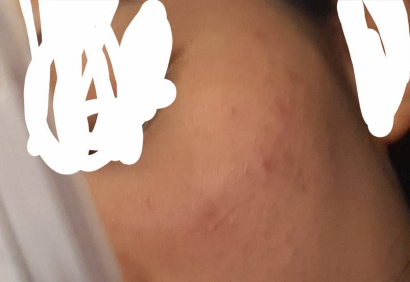 피부 뒤집어진거 맞지 | 인스티즈