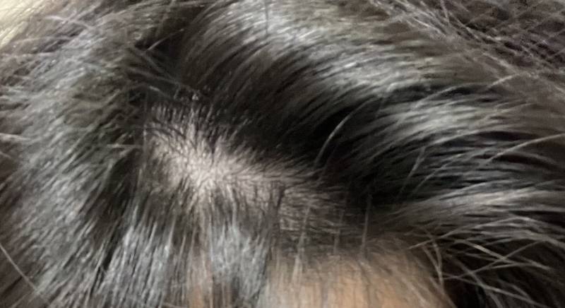 탈모 초기인가요?ㅠ | 인스티즈