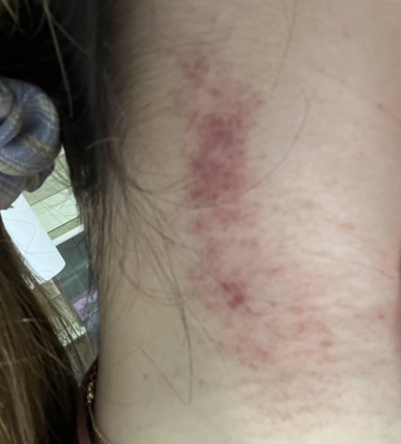 익들아 나 괄사마사지 하다가 이렇게 됐는데 괜찮은 거 맞아? ㅎㅇㅈㅇ | 인스티즈