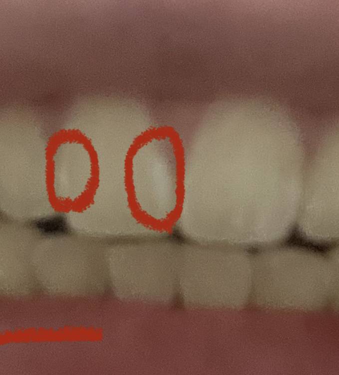 이가 군데군데 하얀건 왜그런거야? 사진 주의 | 인스티즈