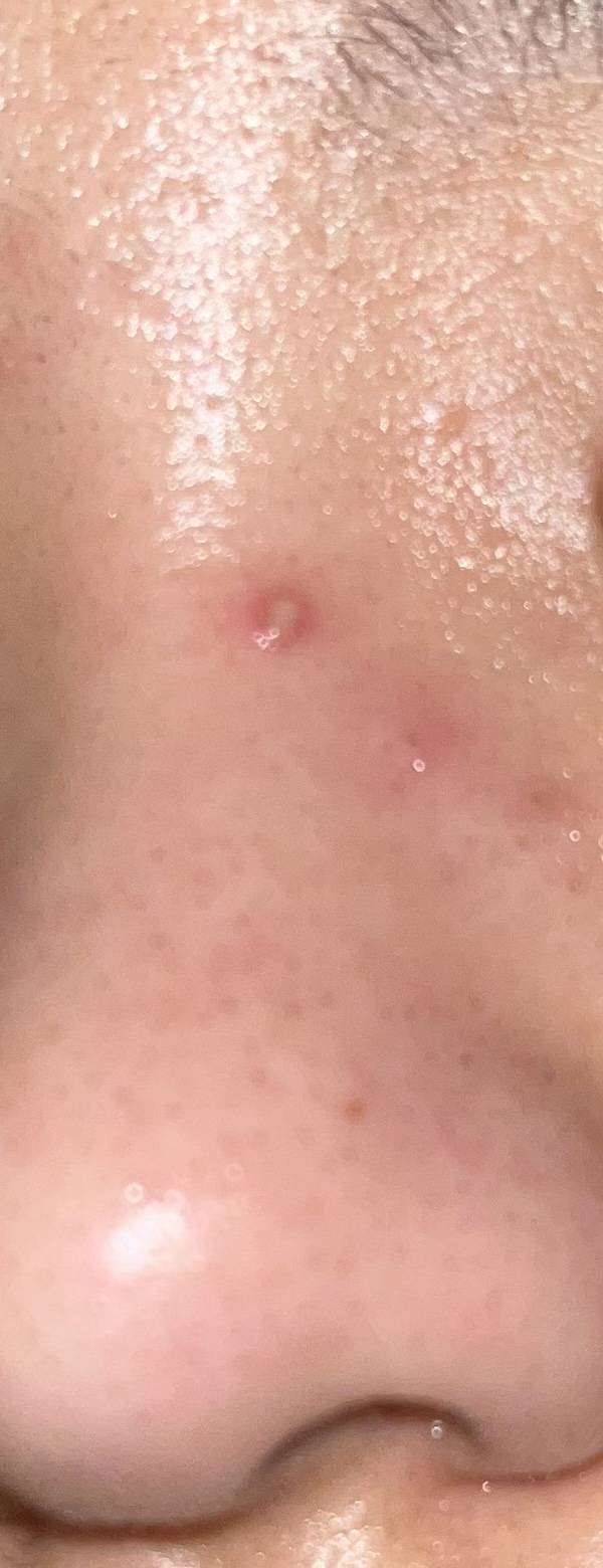 🚨🚨내일 썸남 만나는데 이 여드름 짠다 만다🚨🚨 | 인스티즈