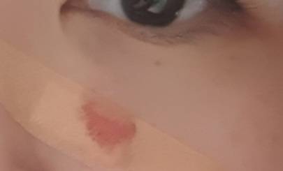 얼굴 긁었는데 피가 계속나;ㅠㅠ | 인스티즈