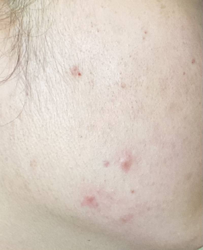 생리때 피부가 이렇게까지 뒤집어져?? ㅎㅇㅈㅇ | 인스티즈