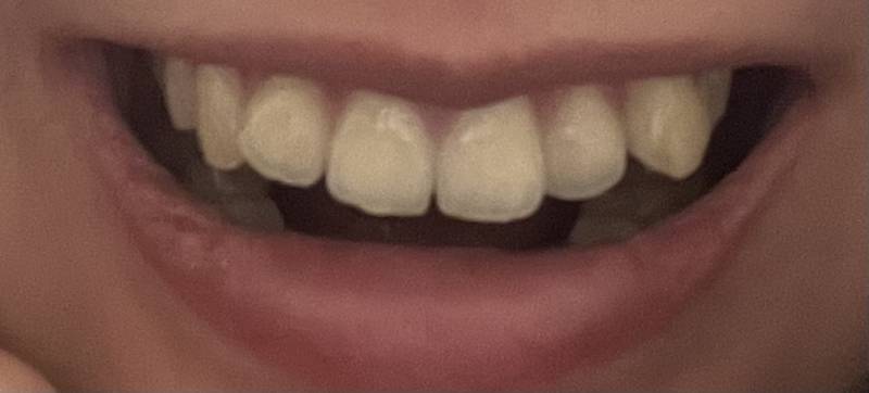 교정해본 사람!! 이정도 덧니를 위해 교정의 고통을 참을 가치가 있을까..? | 인스티즈