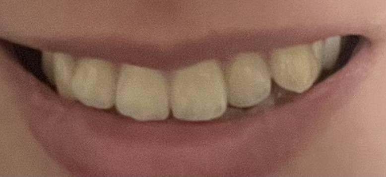 교정해본 사람!! 이정도 덧니를 위해 교정의 고통을 참을 가치가 있을까..? | 인스티즈