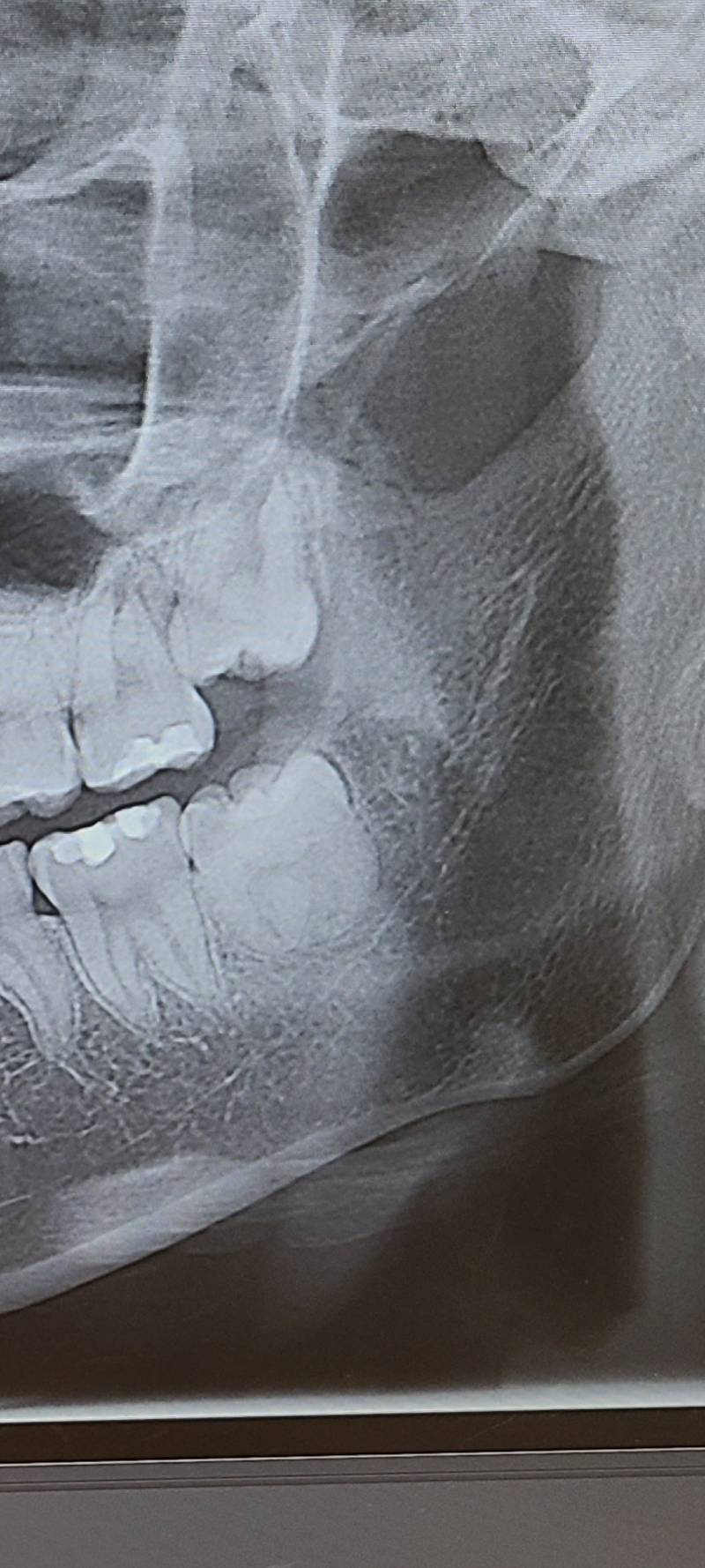 사랑니 얘네들 빼야 할까..?? | 인스티즈