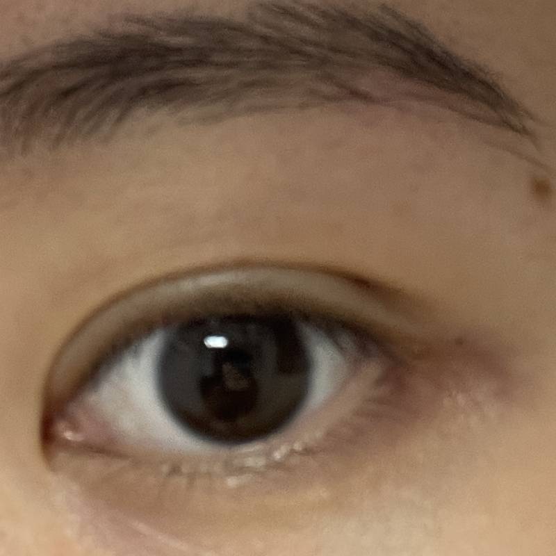 쌍수한지 2주 됐는데 눈 끝라인이 이중라인이고 눈 뜰때마다 접히는 느낌이 이상해 | 인스티즈