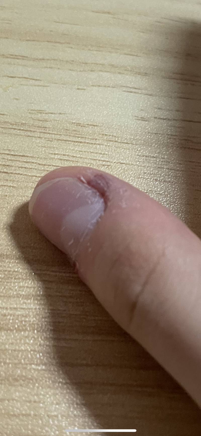 이거 피부 속에서 피터진거야...? 괴사같은 건 아니지...??ㅜㅜ | 인스티즈