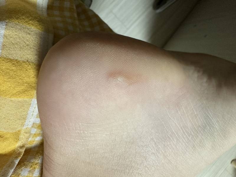 이거 사마귀일까??? | 인스티즈